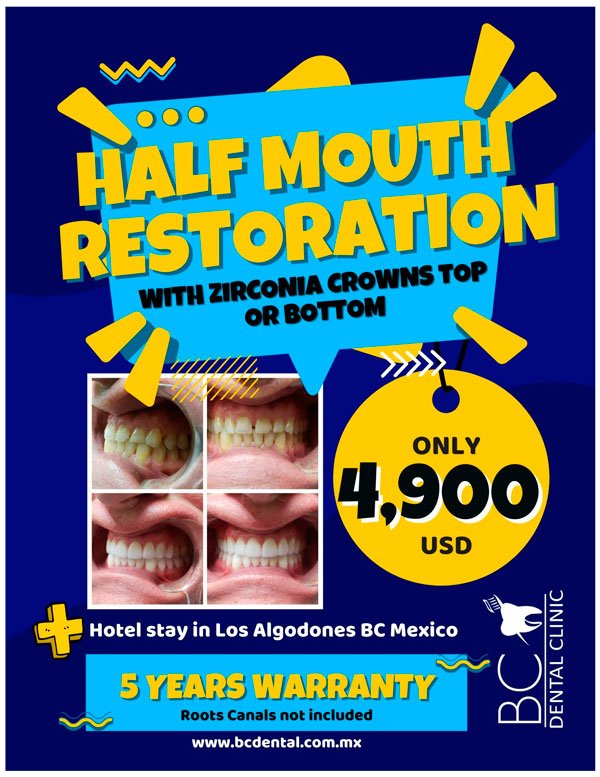 Half Mouth Restoration